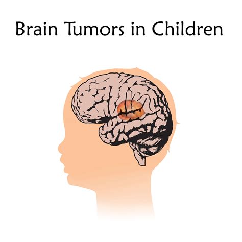 CE Activity | Childhood Brain Tumors | NPs