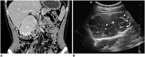 Imaging Patterns Of Intratumoral Calcification In The Abdominopelvic Cavity