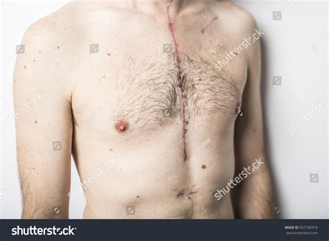 The heart is a muscular organ in most animals, which pumps blood through the blood vessels of the circulatory system. Scar Open Heart Surgery Where Sternum Stock Photo 557182918 - Shutterstock