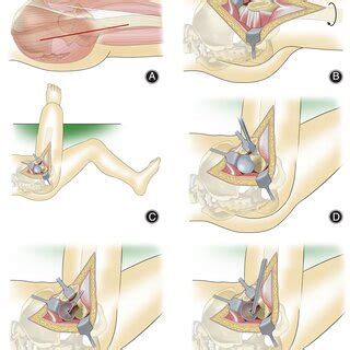 A Ganz Approach B Osteotomy Of The Greater Trochanter
