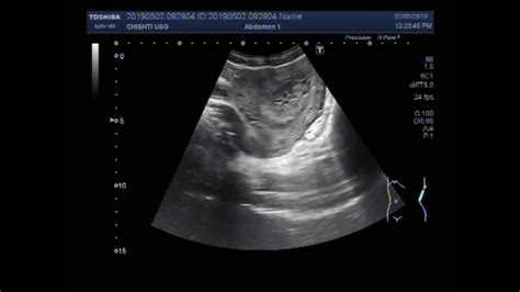 Ultrasound Video Showing Hydatidiform Mole Also Called Molar Pregnancy