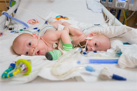Rare Conjoined Twins Successfully Separated