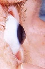 Photos of Keratoconus Lasik Eye Surgery