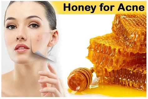 how to use honey to get rid of acne naturally home remedies 2 u besthomeremediesforacne