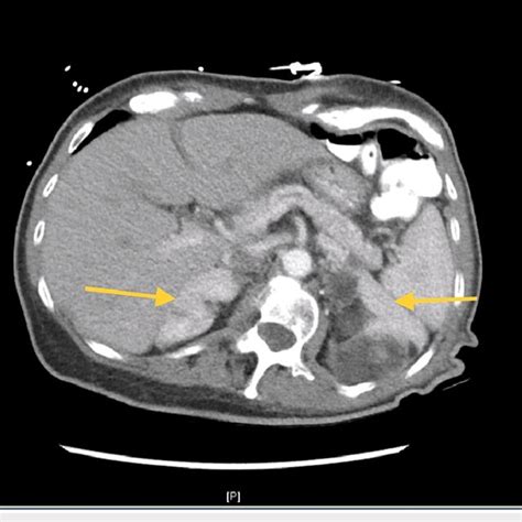 Ct Of The Abdomen With Contrast Showing Bilateral Adrenal Myelolipomas