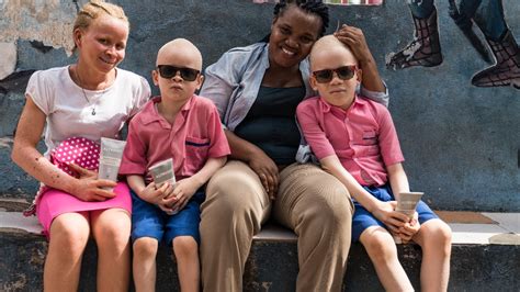 Sun Protection For People With Albinism Stepping Forward