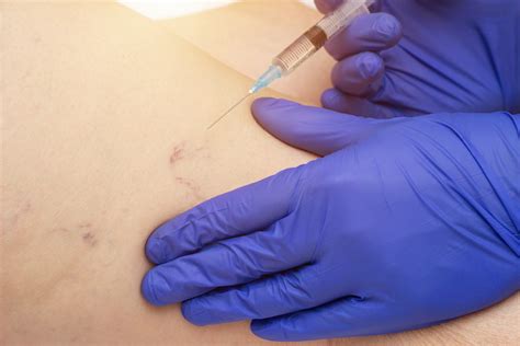 Sclerotherapy Treatment For Spider Veins In Tampa Dr Mackay