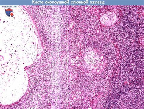 Диета при воспалении слюнной железы Цитология (гистология) биопсии слюнной железы при воспалении Цитология (гистология) биопсии слюнной железы при воспалении Диета при воспалении слюнной железы