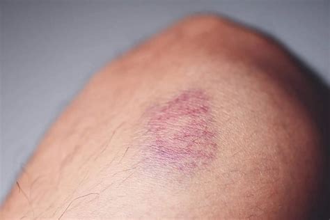 Hematoma Subgaleal O Popular Galo Na Cabeça Aprenda Mais Blog Da Saúde