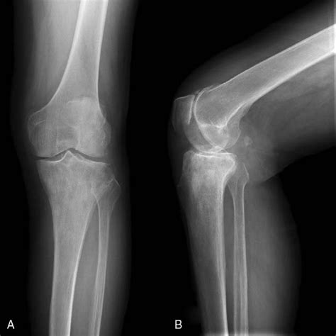X Ray Radiographs Of The Right Knee Showing The High Density Signal In