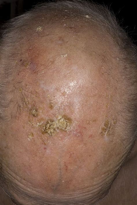 Kinds Of Skin Cancer Types Skin Cancer On Scalp Pictures â€“ 20