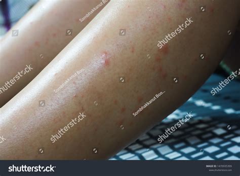 Legs Dermatology Skin Rashes Infection Allergies Stock Photo 1470935399