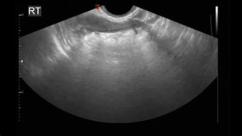 6 Femvue Ultrasound Bilateral Tubal Occlusion 1 Youtube