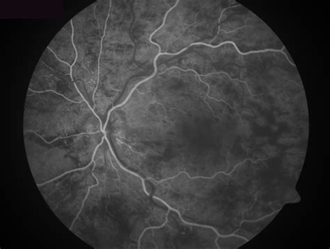 Ischemic Central Retinal Vein Occlusion Retina Image Bank