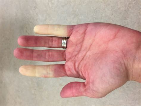 Raynauds Disease Diagnosis And Treatments Dont Get Left Out In The