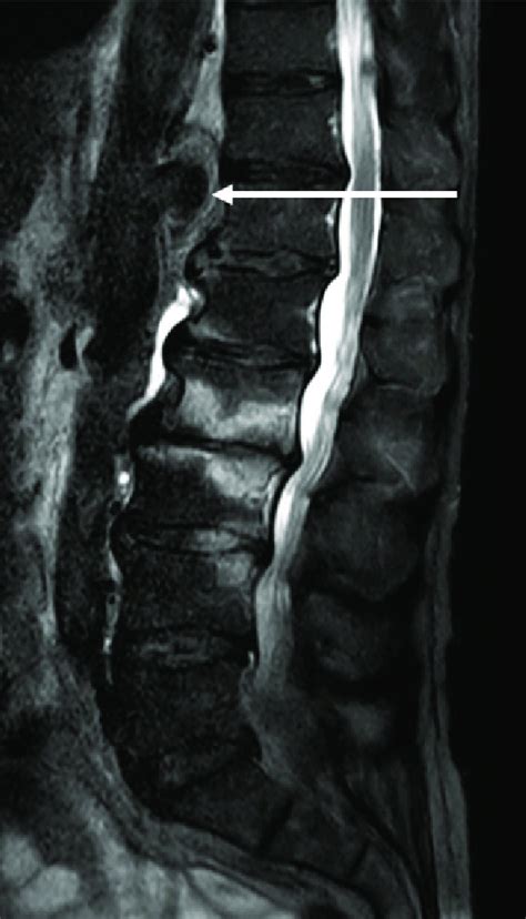 Sagittal T Weighted Images With Fat Suppression Of The Lumbar Spine