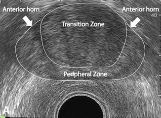 Ultrasound For Prostate Biopsy Radiology Key