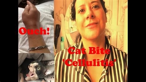 Cat Bite Cellulitis My Story Youtube