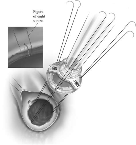 Sutureless Aortic Valve Implantation Operative Techniques In Thoracic And Cardiovascular Surgery