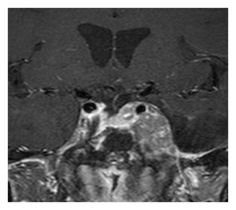 Pituitary T1 Weighted Postgadolinium Coronal Mris Before A And After