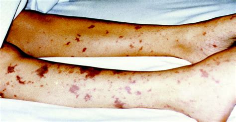 8 Management Of Allergy Rashes And Itching Emergency Medicine Journal