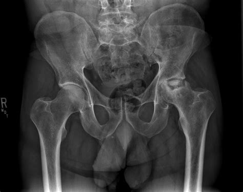 Ortho Dx Alcoholism Induced Avascular Necrosis Of The Hip Clinical