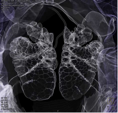 A response that the parenchyma tumor is in the peripheral lung. Variant of Lung Parenchyma and Airways in a Turtle ...