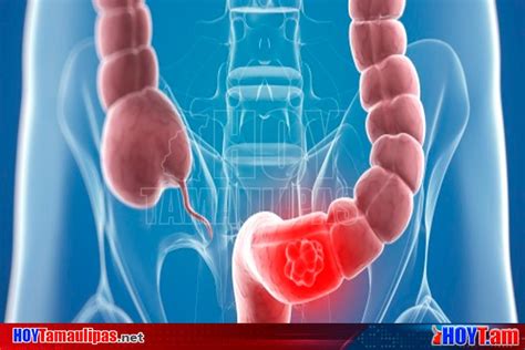 Get the facts on colon cancer (colorectal cancer) symptoms, stages, treatment, screening, causes, surgery, and survival. Hoy Tamaulipas - Tomar conciencia para prevenir detectar y ...