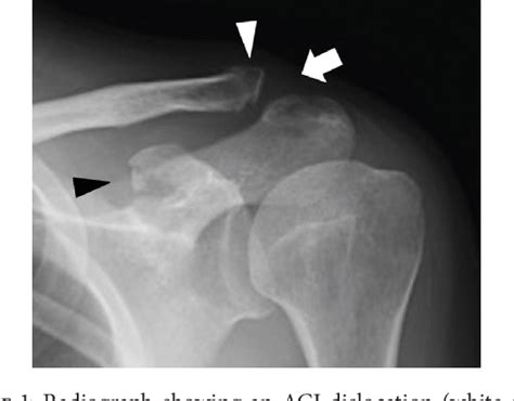 Figure 1 From Coracoid Process Avulsion Fracture At The