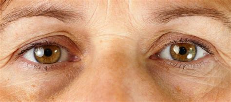 Do You Have Raccoon Eyes What Causes Them And How To Fix