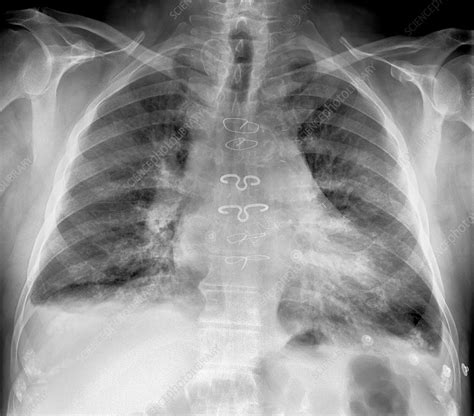 Prosthetic Heart Valve X Ray Stock Image C0177828 Science Photo