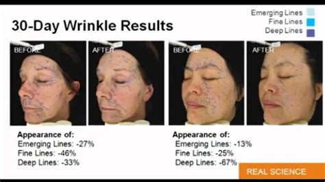 Best Product Deep Forehead Wrinkles Say Bye Bye To Deep Forehead