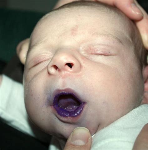 How To Use Gentian Violet For Thrush In Babies Dane101