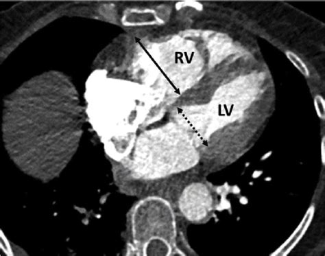 Measurement Of Rv And Lv Diameter On Axial Ctpa Image The Ventricular