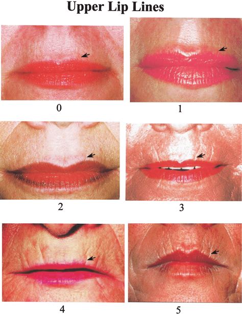 Wrinkle Assessment Scale Of Upper Lip Lines Download Scientific Diagram