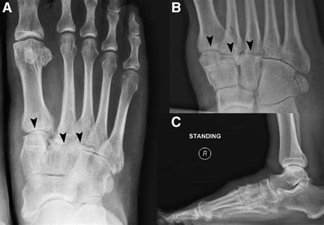 Arthroscopic Tarsometatarsal Arthrodesis Of The Right Foot