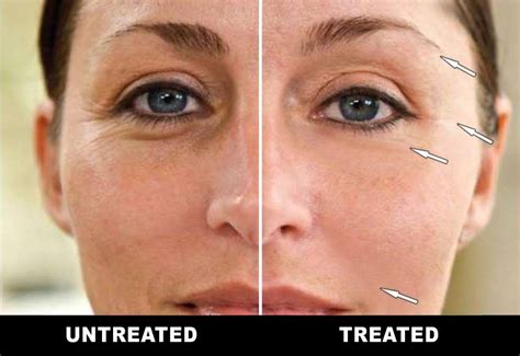 Look Younger With Microcurrent Facial Toning Guaranteed