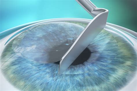 Prklasek Laser Eye Surgery Medical Technology │ Zeiss