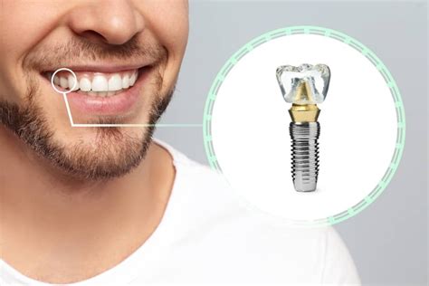 What You Didnt Know About Dental Implants Houston Tx