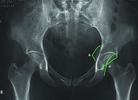 2 Fai Pincer Lesion On An Anteroposterior Radiograph A Crossover