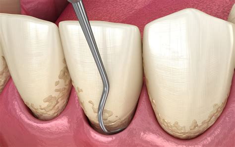 ¿qué Es El Curetaje Clínica Dental Collado Villalba