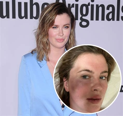 Ireland baldwin sizzles in risqué bra and underwear on instagram. Ireland Baldwin Shares MASSIVE Bruise After Being ...