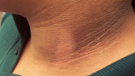 Consejos Para Prevenir Oscurecimiento En Axilas Y Cuello En El Embarazo