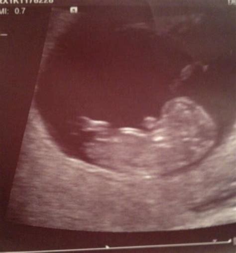 Missedhidden Twin On Early Ultrasound