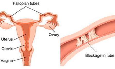 Non Surgical Opening Of Blocked Fallopian Tubes By FTR