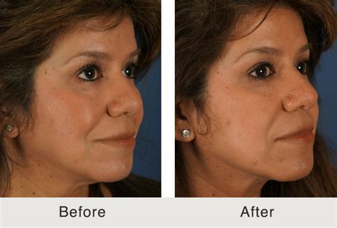 Before And After Fillers To Cheeks In Charlotte Carolina