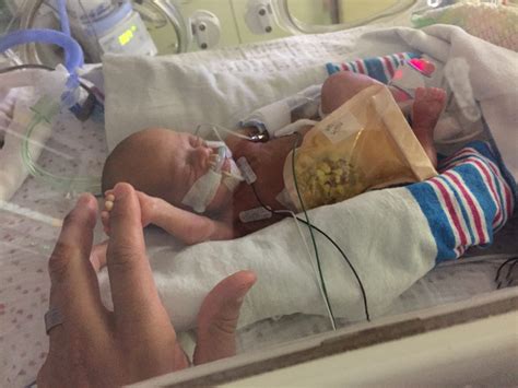Born Premature At Weeks Baby Marlo Is A Miracle