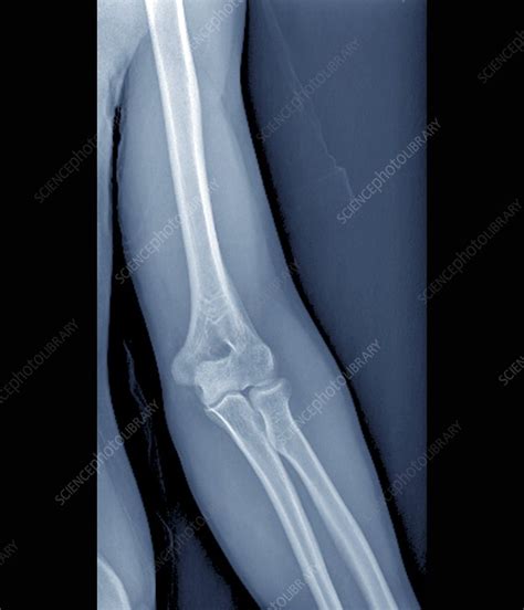 Normal Elbow Joint X Ray Stock Image F0027547 Science Photo Library