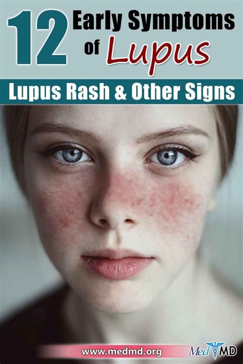 12 Early Symptoms Of Lupus Lupus Rash And Other Signs