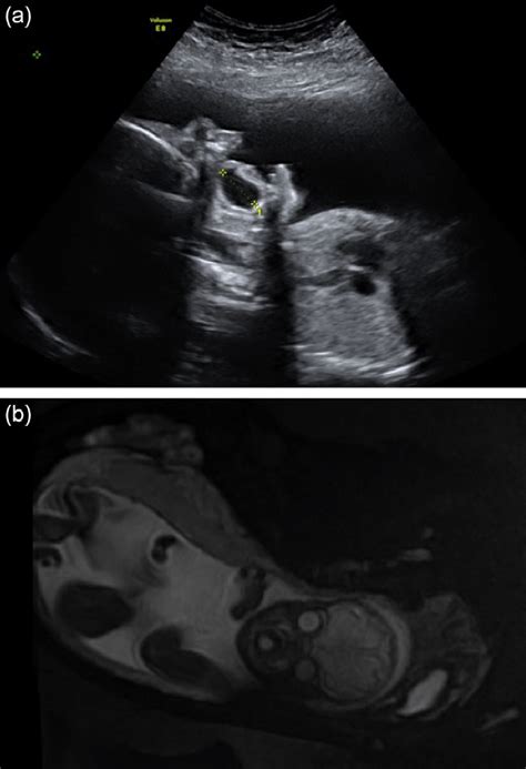 A And B Antenatal Ultrasound At 28 Weeks And Mri Scan At 31 Weeks